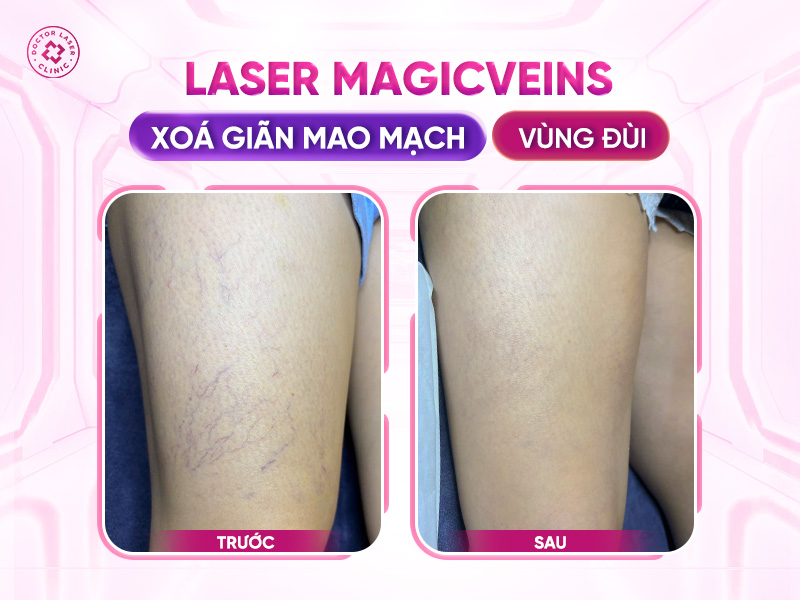 Kết quả điều trị giãn mao mạch chân tại Doctor Laser