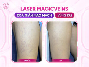 ket-qua-dieu-tri-gian-mao-mach-chan-tai-doctor-laser