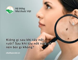 kieng-gi-sau-khi-tay-not-ruoi