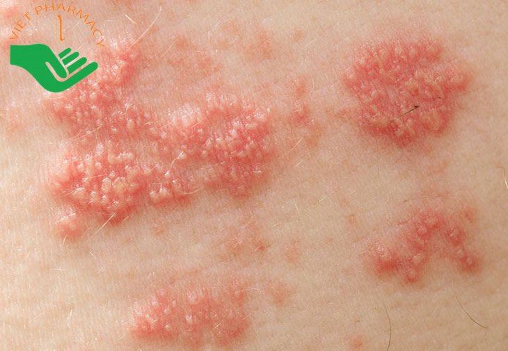 Lưu ý khi sử dụng thuốc bôi trị giời leo