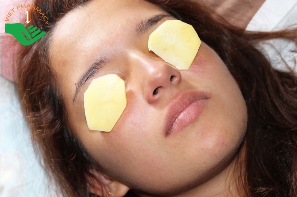 Dúng khoai tây cắt lát đắp lên mắt để giảm ngứa nhanh chóng