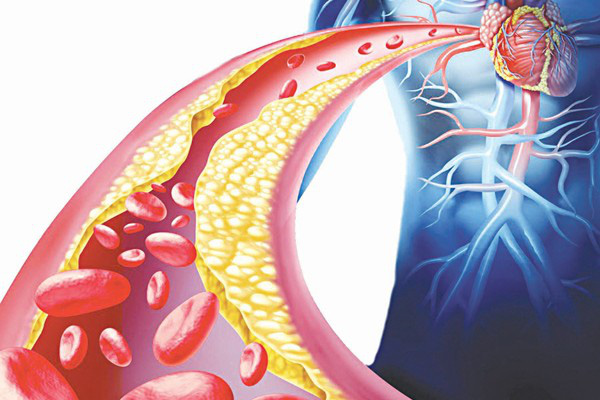 Mỡ máu cao gây ra nhiều biến chứng cho người bệnh