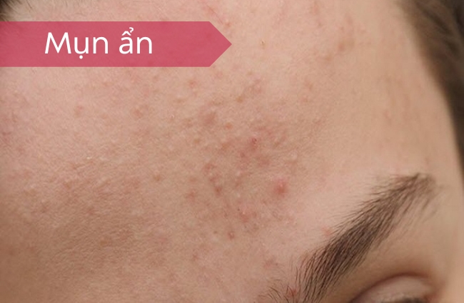 Tìm hiểu về mụn ẩn