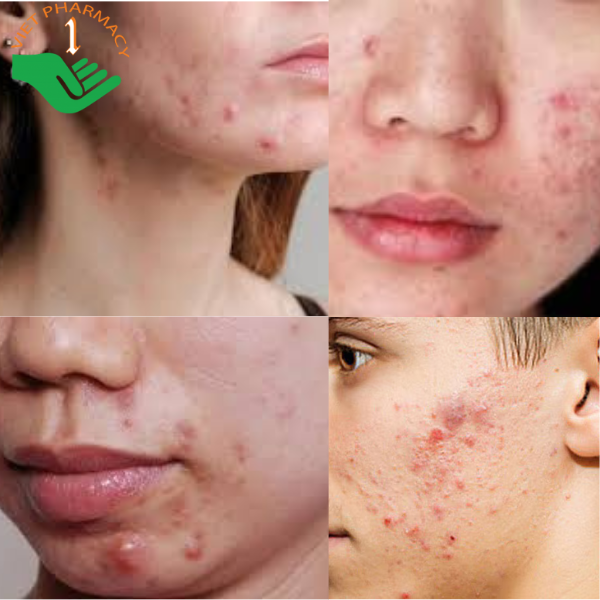 Mụn bọc gây mất thẩm mỹ và sưng đau