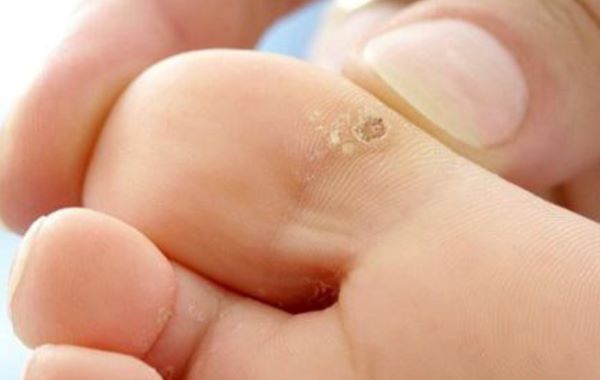 mun-coc-long-ban-chan Mụn cóc ở lòng bàn chân do virus HPV gây ra