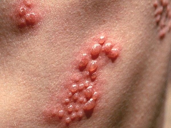 Mụn nước tập trung thành chùm trong bệnh zona thần kinh