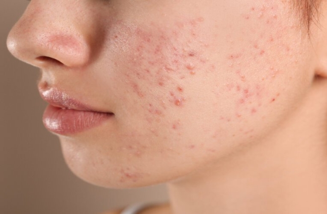 Những điều cần biết về mụn trứng cá