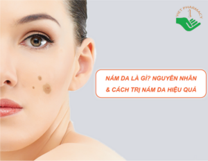 Nám da là gì? Nguyên nhân và Cách trị nám da hiệu quả mà bạn phải biết nam-da-la-gi-cach-tri-nam-da-hieu-qua