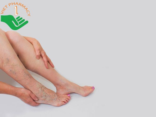 Giãn tĩnh mạch ở chân khiến người bệnh vừa đau đớn lại vừa mất tự tin