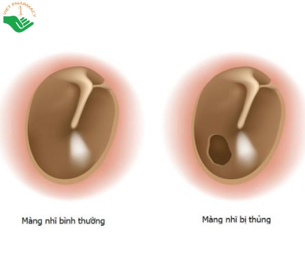 Nguyên nhân dẫn đến thủng màng nhĩ