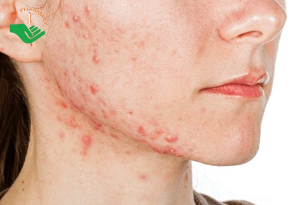 Mụn trứng cá đỏ phổ biến ở phụ nữ