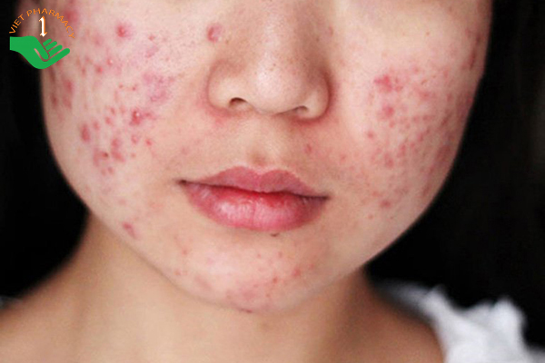 Người bị mụn không nên uống tảo biển