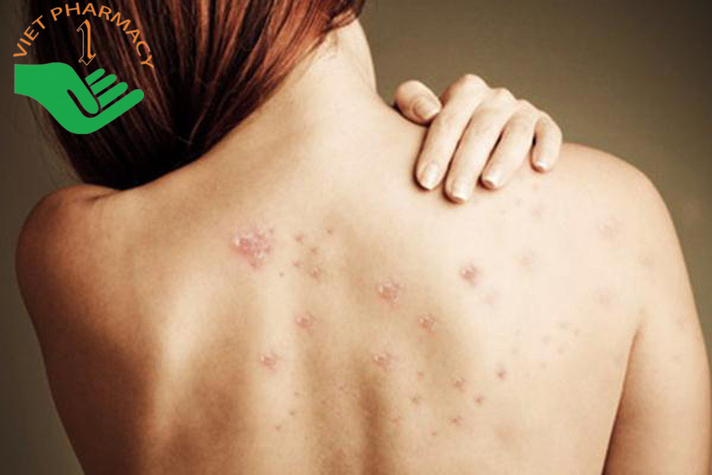 Mụn bọc ở lưng do nhiều nguyên nhân gây ra