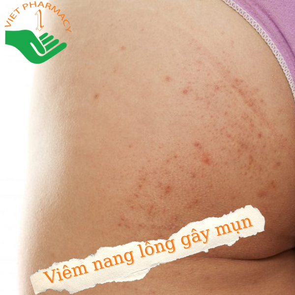 Mụn mông do bị viêm nang lông