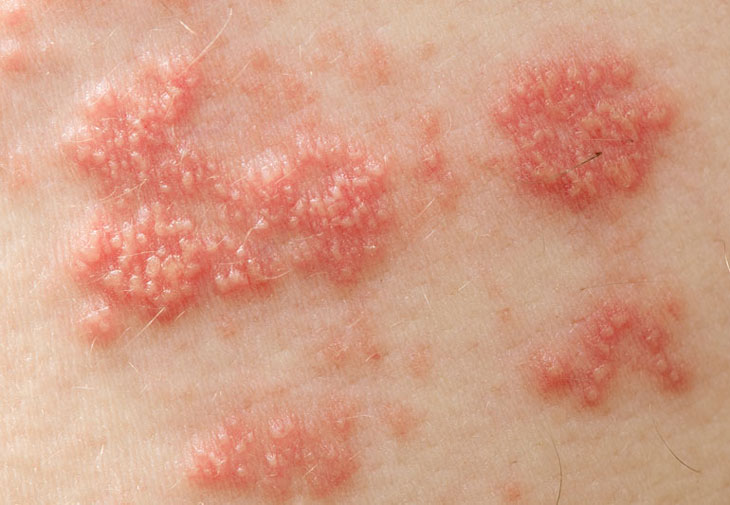 Zona do virus Varicella-zoster gây ra