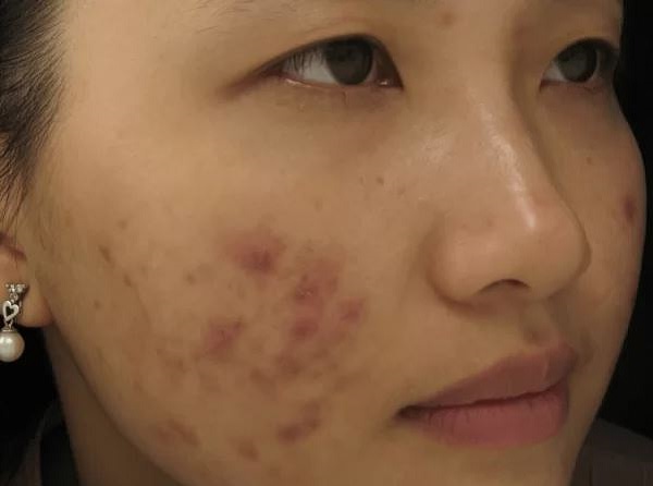 Nguyên nhân gây thâm mụn