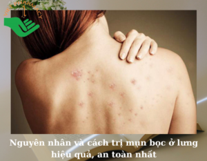 nguyen-nhan-va-cach-tri-mun-boc-o-lung-hieu-qua-an-toan-nhat