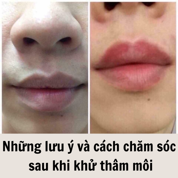 Những lưu ý và cách chăm sóc sau khi khử thâm môi