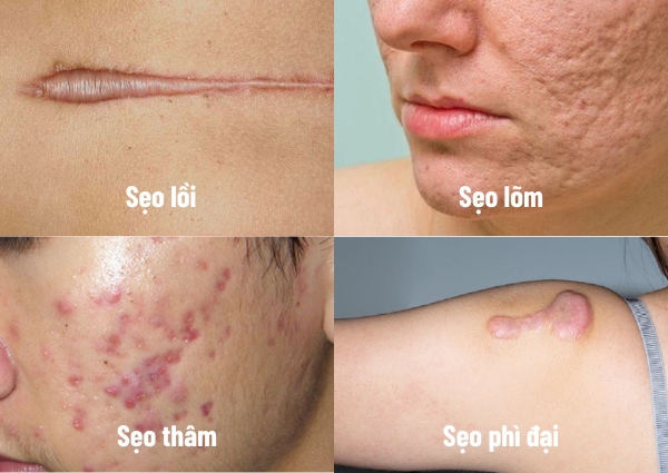 Các loại sẹo thường gặp