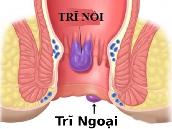 Phân loại trĩ
