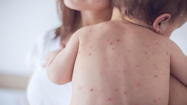 Phát ban là một tình trạng về da thường gặp và xuất hiện trên sau khi bé bị sốt