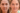 Phục hồi da bằng liệu pháp Laser Resurfacing
