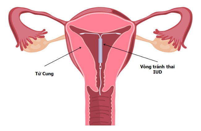 Quy trình đặt vòng tránh thai