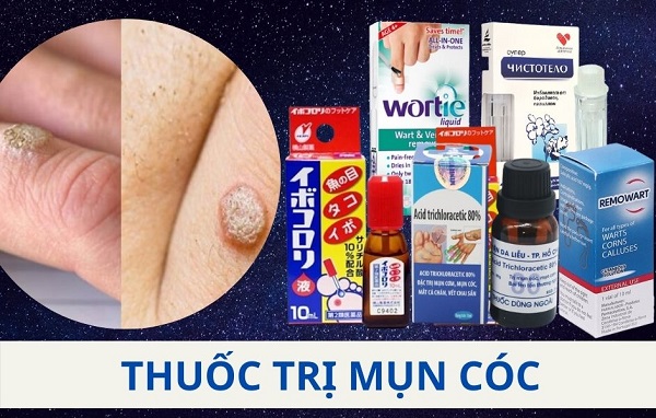 review-5-loai-thuoc-tri-mun-coc-tot-nhat-hien-nay Review 5 loại thuốc trị mụn cóc tốt nhất hiện nay