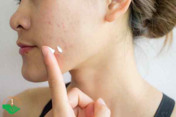 Sản phẩm trị mụn nên có hướng dẫn từ bác sĩ