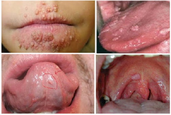 Sùi mào gà ở lưỡi, miệng