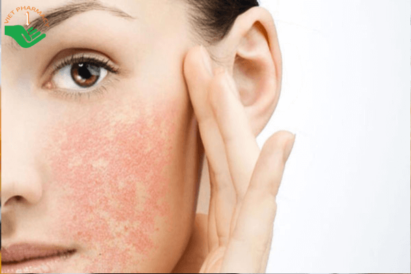 Cơ địa dễ bị nổi mẩn hoặc dị ứng