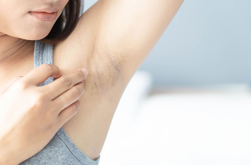 Nguyên nhân khiến nách bị thâm sạm, tối màu