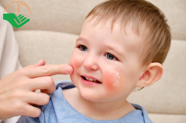 Chọn kem trị chàm sữa cho bé