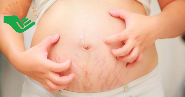 Tiêu chí chọn kem trị rạn da