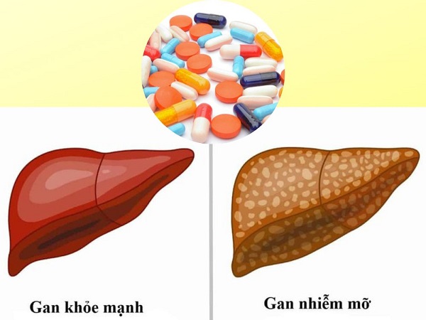 Top 7 thuốc trị gan nhiễm mỡ tốt nhất và hiệu quả nhất hiện nay