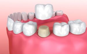 Việc phối hợp giữa 2 phương pháp trám răng inlay onlay và bọc răng sứ hỗ trợ răng không chỉ thẩm mỹ mà còn cứng cáp, chắc khỏe, tăng tuổi thọ