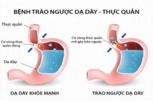 trao-nguoc-da-day-thuc-quan