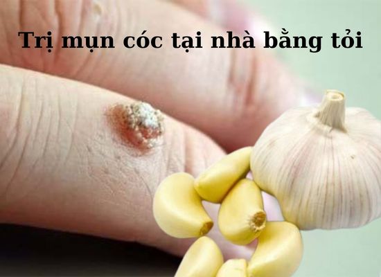 Trị mụn cóc tại nhà bằng tỏi
