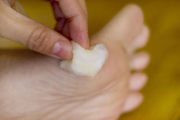tri-mun-coc-bang-acid-salicylic Acid Salicylic dần dần phá bỏ nốt mụn cóc và ngăn cản sự lây lan của virus HPV