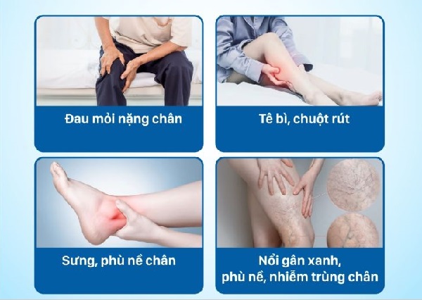 Triệu chứng của suy giãn tĩnh mạch