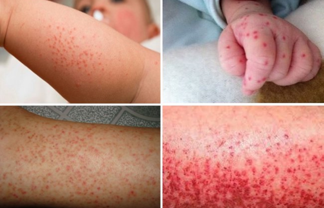 Lưu ý những triệu chứng sốt xuất huyết nặng khi điều trị tại nhà