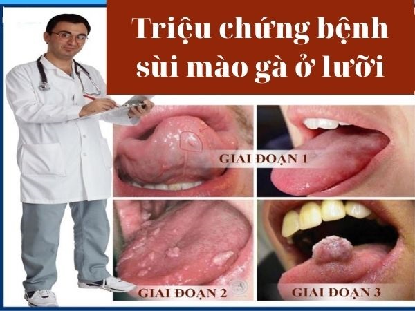 Triệu chứng bệnh sùi mào gà ở lưỡi, miệng