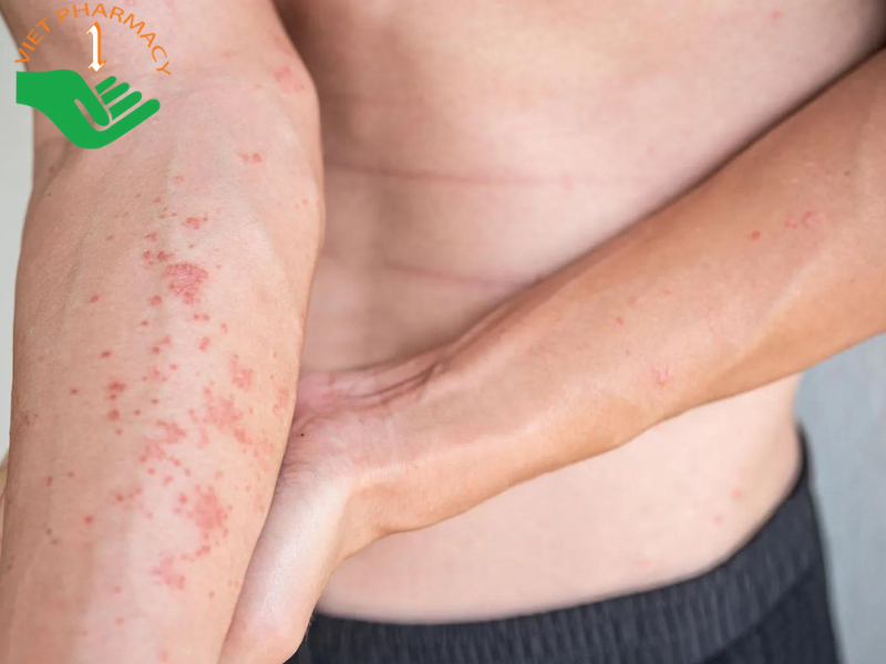 Viêm da tiếp xúc dị ứng bao lâu thì khỏi tùy tình trạng bệnh