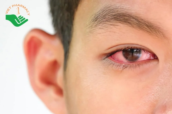 Tình trạng viêm kết mạc là một trong những nguyên nhân gây sưng mắt khi ngủ dậy