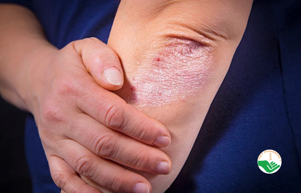 Viêm khớp vảy nến thường gặp trên người bị vảy nến