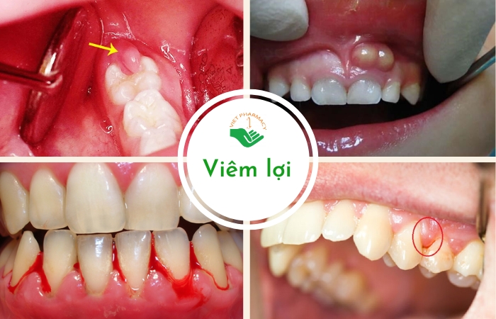 Hình ảnh viêm lợi