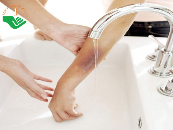 Xử lý khi bị bỏng tránh để lại sẹo