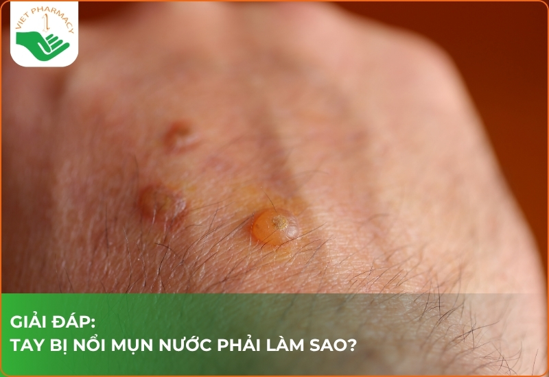 Giải đáp: Tay bị nổi mụn nước ngứa phải làm sao?