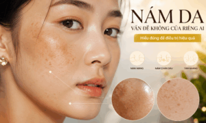 Dựa trên loại nám và mức độ mà chọn loại kem trị nám phù hợp với bản thân mình