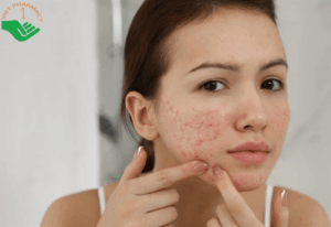 Nặn mụn xong nên bôi gì để không bị thâm?